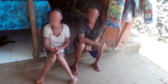 Sejak lahir, 4 warga Buleleng ini menderita penyakit sisik ular