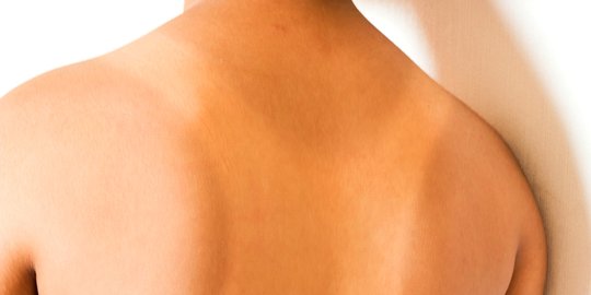 [Infografis] Cara ampuh pulihkan kulit belang terbakar matahari