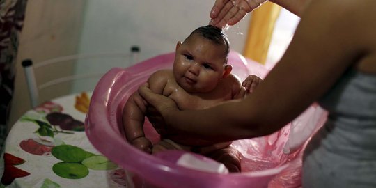 Kisah haru bayi Maria terjangkit virus Zika