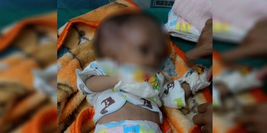 Bayi 41 hari pengidap hydrocepalus di Gianyar kesulitan berobat