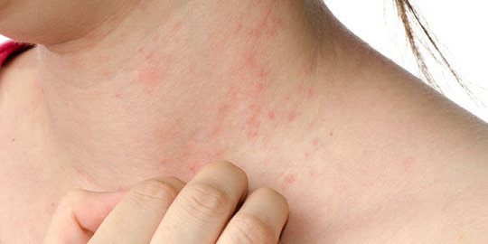 6 penyebab tak wajar muncul rasa gatal di pantat