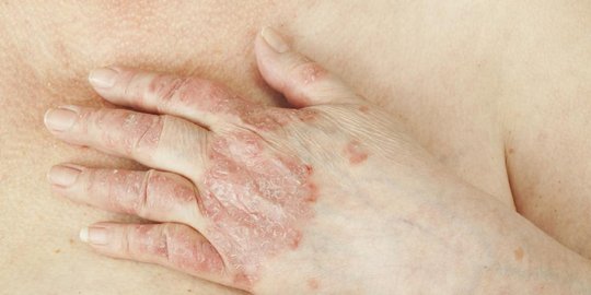 6 penyebab tak wajar muncul rasa gatal di pantat