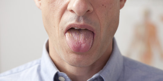Selain kotor, ini 4 alasan lainnya muncul lapisan putih di lidah