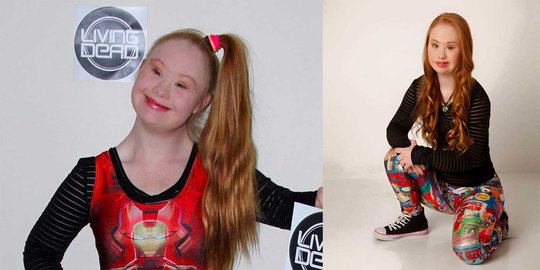 Hari down syndrome sedunia, jadikan dunia lebih adil yuk!