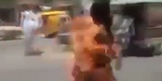 Pria ini terbakar akibat ponselnya meledak saat ditaruh di saku