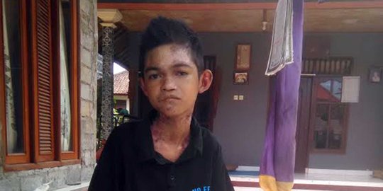 Remaja di Bali mengidap penyakit aneh, tubuh melepuh dan luka
