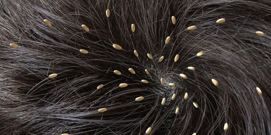8 Hal yang tidak kamu ketahui tentang kutu rambut 