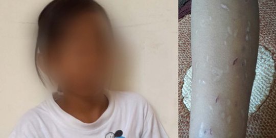 Miris, bocah kelas 3 SD dicubit ibu tiri sampai berdarah