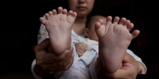 Bayi di China terlahir dengan 31 jari di tangan dan kaki