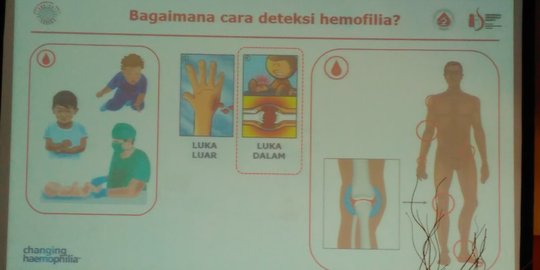 Bahaya Hemofilia hingga pernah dianggap penyakit kutukan