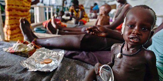 Potret memilukan bocah penderita gizi buruk di Sudan Selatan