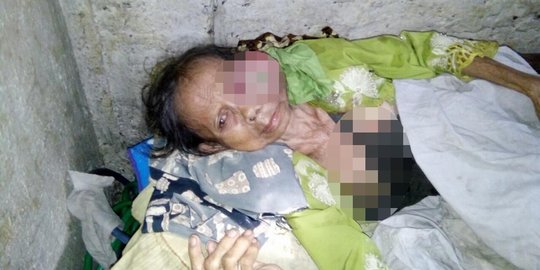 Derita Nenek Kalimah, pengidap tumor yang tidak tercover BPJS