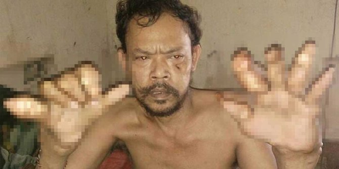 Penyakit aneh gerogoti seluruh jari Sariawan selama 3 tahun