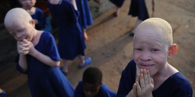 Dianggap bawa hoki, orang Albino di Afrika diburu dan dibantai