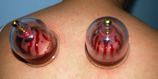 Pengobatan dan obat yang dianjurkan Rasulullah