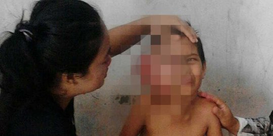 Andini terpaksa berhenti sekolah akibat serangan tumor ganas