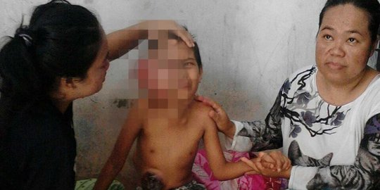 Andini yang mengidap tumor akhirnya bisa dirawat di rumah sakit