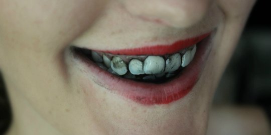 7 cara ampuh memutihkan gigi dengan bahan alami