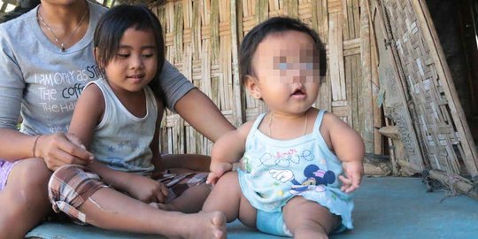 Bayi kurang gizi di Bali, terlahir cacat tubuh dan hampir buta