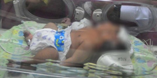 Cerita haru bayi berkepala dua di Gresik akhirnya meninggal dunia