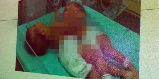 Bayi kembar siam yang berhasil dipisah diberi nama Gisya dan Gesya