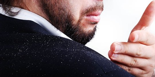 disebabkan oleh kulit kepala kering rev1