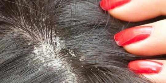 gatal belum tentu karena ketombe rev1