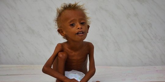 Potret ironis anak-anak korban busung lapar akibat perang Yaman