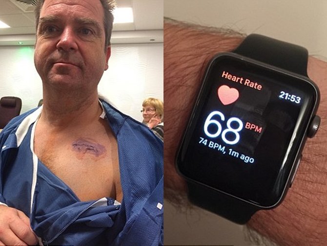 dosen yang nyawanya terselamatkan berkat apple watch