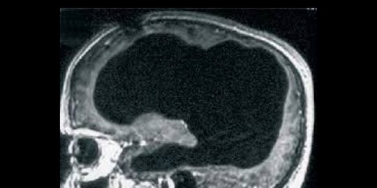 hidup dengan hampir tak punya otak