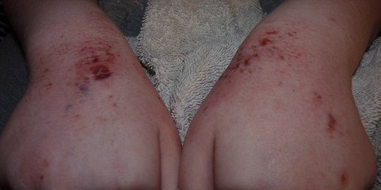 gadis ini harus hidup seperti drakula rev4