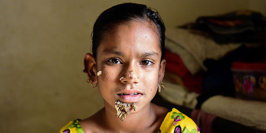 Meratapi gadis Bangladesh derita sindrom manusia pohon