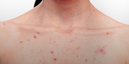 5 Bahan alami ini ampuh untuk sembuhkan jerawat di badan