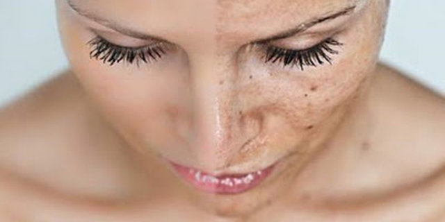 Ini 8 Bahan Alami Paling Terpercaya Buat Atasi Hiperpigmentasi Merdeka Com