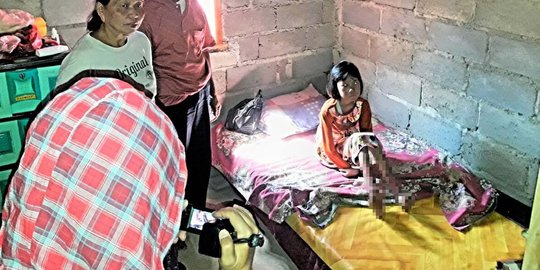 Usai minum obat dokter, kaki siswi SD ini melepuh dan tak bisa jalan