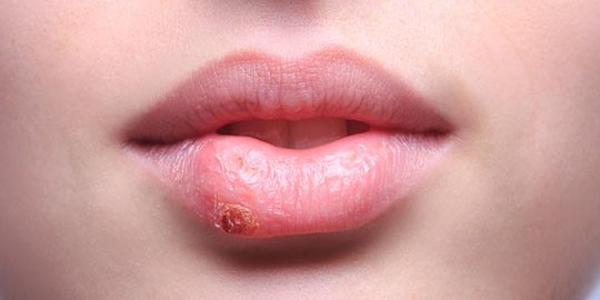 Tips merawat bibir agar tidak kering selama berpuasa