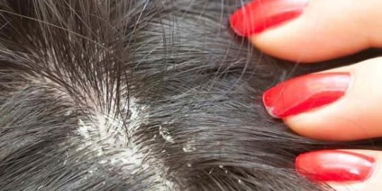 Selain jamur, stres juga bisa bikin rambut berketombe