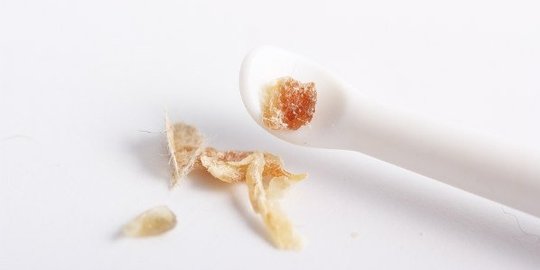 tebak penyakit yang kamu derita dari warna kotoran telinga