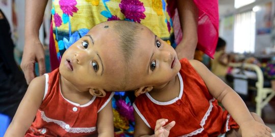 Potret pilu bayi kembar di Bangladesh berkepala dempet
