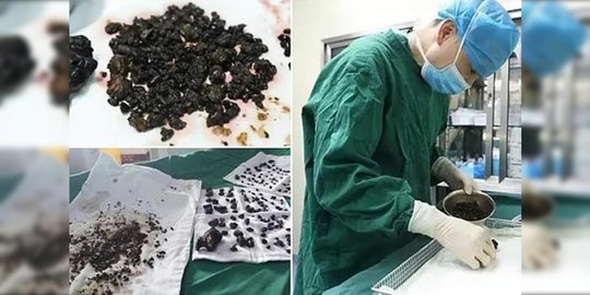 5 hal mengerikan yang pernah diangkat dokter dari tubuh manusia
