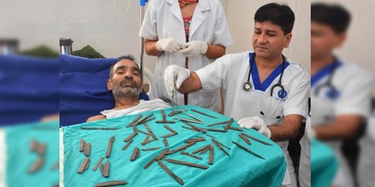5 hal mengerikan yang pernah diangkat dokter dari tubuh manusia