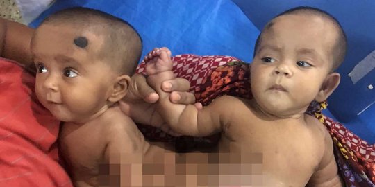 24 Dokter ahli bedah Bangladesh berhasil pisahkan bayi kembar siam