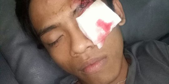 Suara motor terlalu keras, Usman dilempari batu sekelompok pemuda mabuk