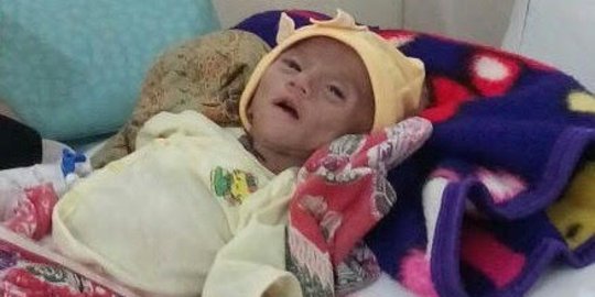 Derita bayi Yusuf, berat badan menyusut karena sakit usus 