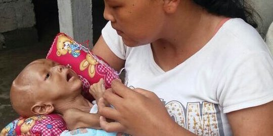  Bayi  kelainan kelenjar keringat di Gianyar ini butuh 