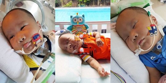 Trisomy 13, kelainan kromosom tubuh yang renggut nyawa bayi Adam