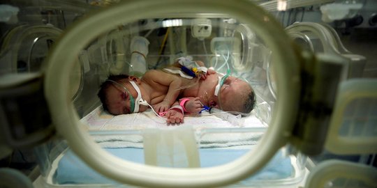 Potret haru bayi kembar siam asal Gaza berhasil dipisahkan