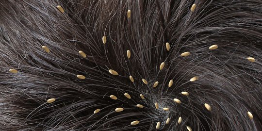 9 Cara Menghilangkan Kutu Rambut Dan Telurnya Secara Alami Dan Permanen Merdeka Com
