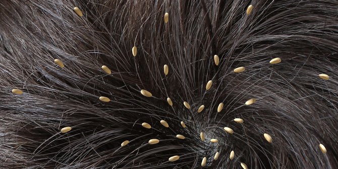 9 Cara menghilangkan kutu rambut dan telurnya secara alami dan permanen