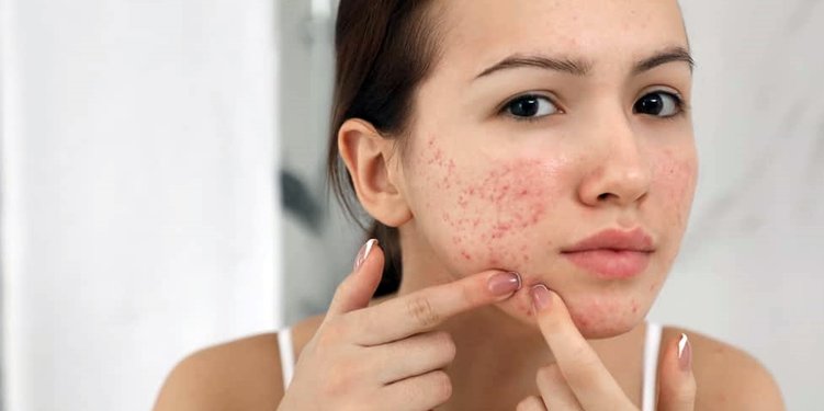 Kulit Beruntusan Setelah Coba Skincare Purging Atau Iritasi Ketahui Bedanya Merdeka Com